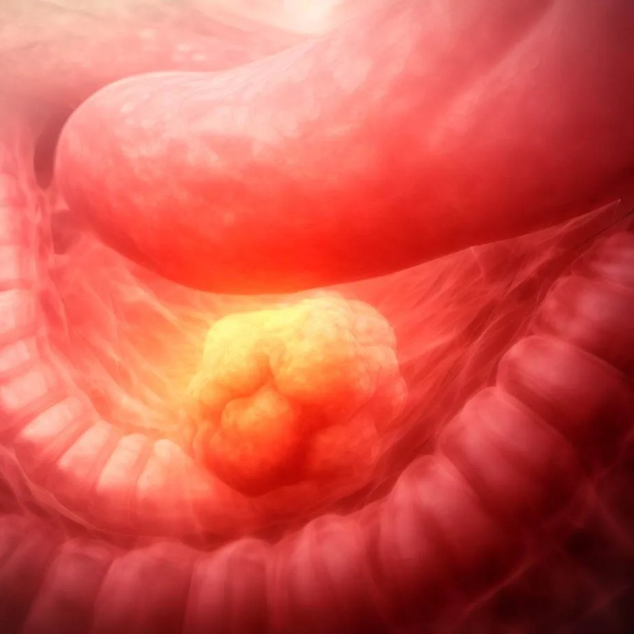 Rozlany rak żołądka - Skuteczne Metody Diagnozowania i Leczenia